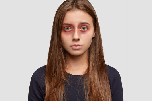 Mujer con alergias en los ojos
